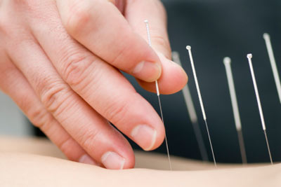 Does Acupuncture for Weight Loss Work?