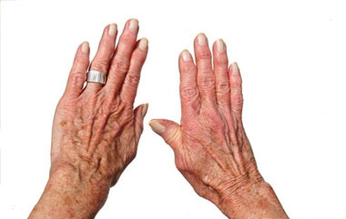 Osteoarthritis and Being Overweight