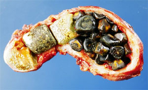 The Facts on Gallstones